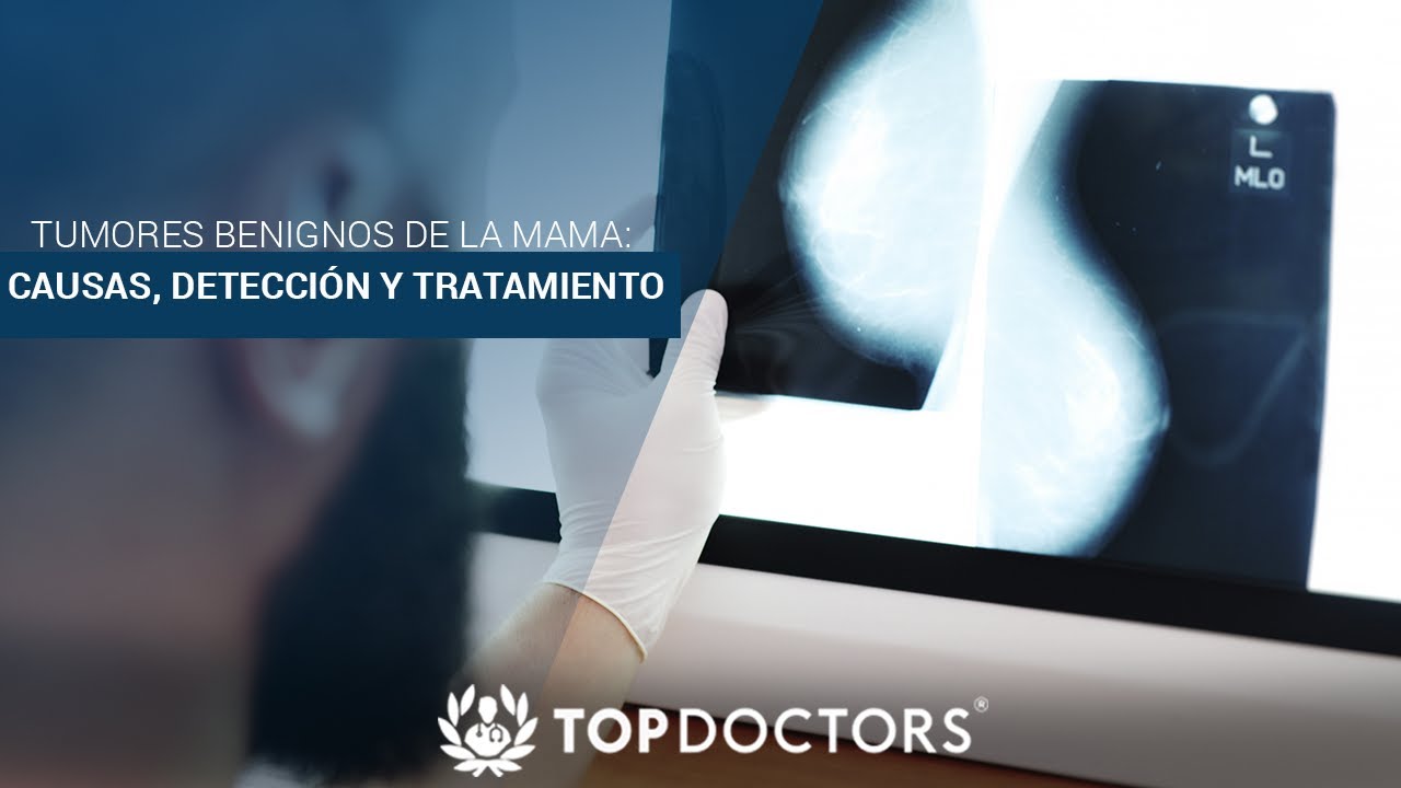 Tumores Benignos de la Mama: causas, detecci&oacute;n y tratamiento