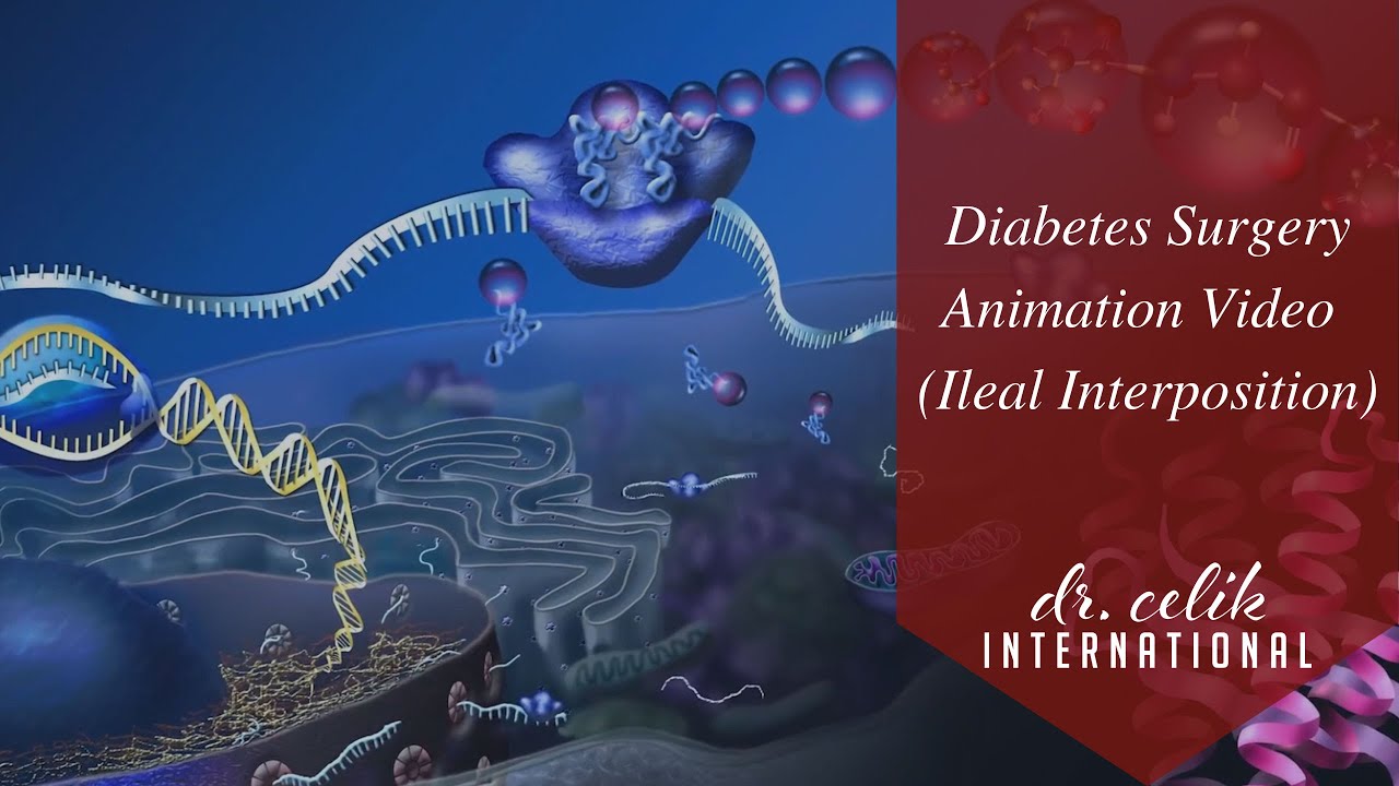 Diabetes Surgery Animation Video I (Ileal Interposition)