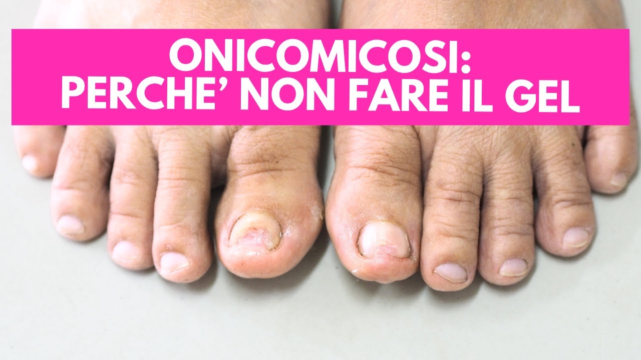 Onicomicosi: perché NON fare il gel