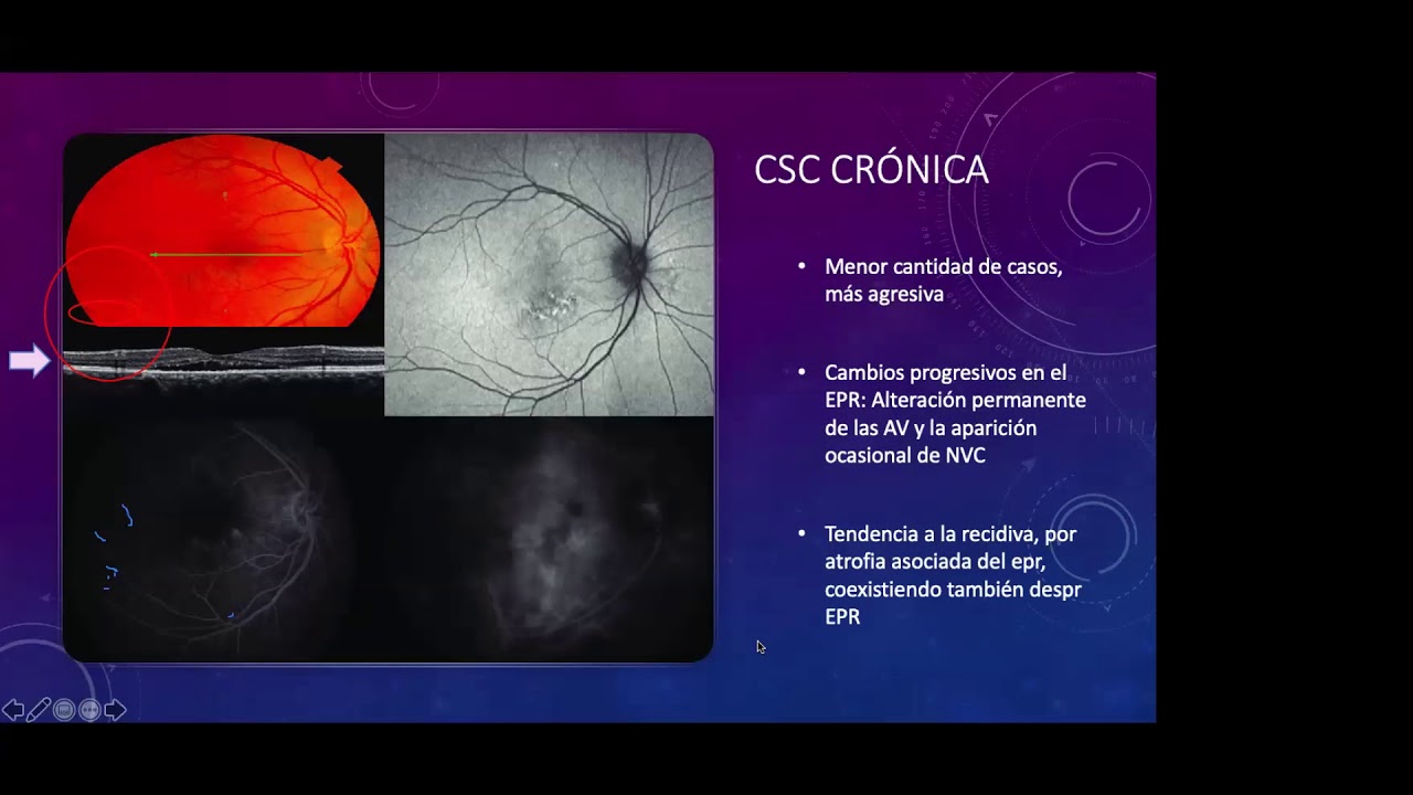 CORIORRETINOPATIA CENTRAL SEROSA. MANEJO ACTUAL - DR. EDUARDO ESCOBEDO