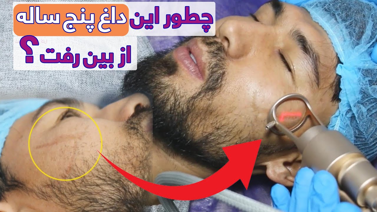 لیزر داغ بخیه پنج ساله در شفاخانه جلدی کارا