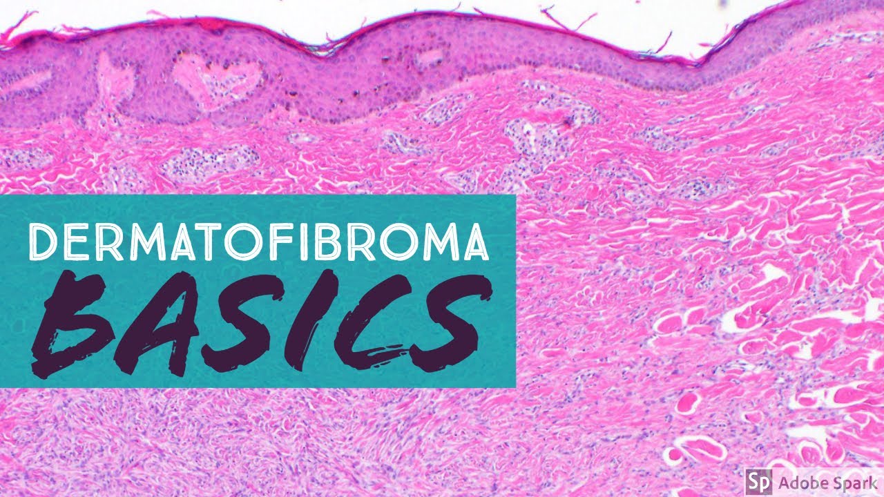Dermatofibroma 101 (Benign Fibrous Histiocytoma)...Explained by a Dermatopathologist