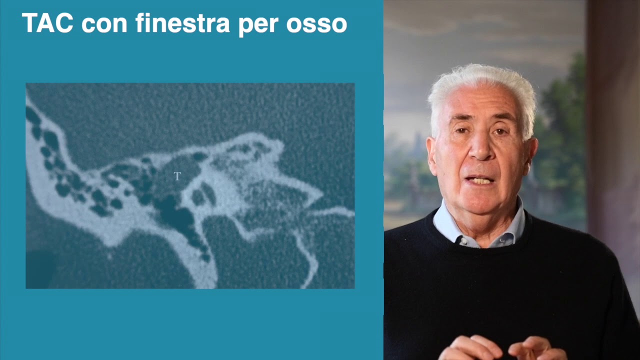 Prof. Mario Sanna - Tumori del Nervo Facciale