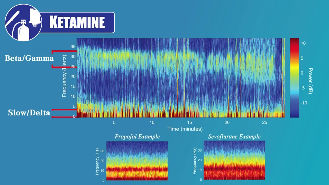 EEG for Anesthesiology - Part 5: Ketamine