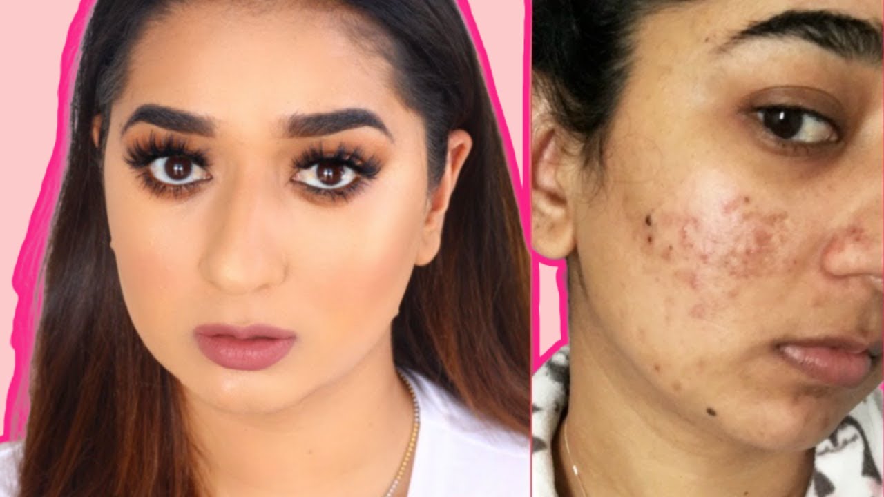 Hindi Video How To Cover Acne & Scars | Easy Makeup Transformation Routine  (IF You Want To)