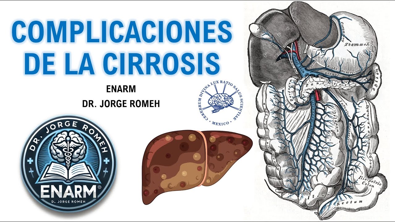 COMPLICACIONES DE LA CIRROSIS - ENARM - TODO LO QUE DEBES SABER