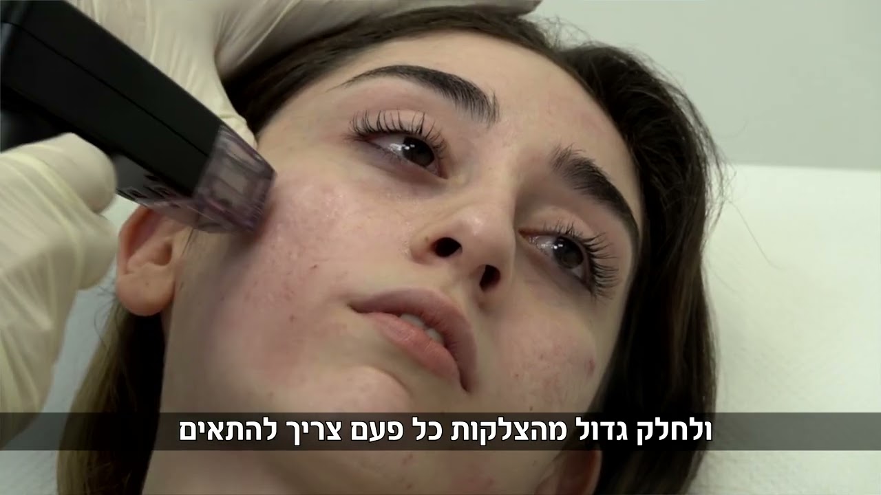 סרט שיווקי  - טיפול בצלקות אקנה