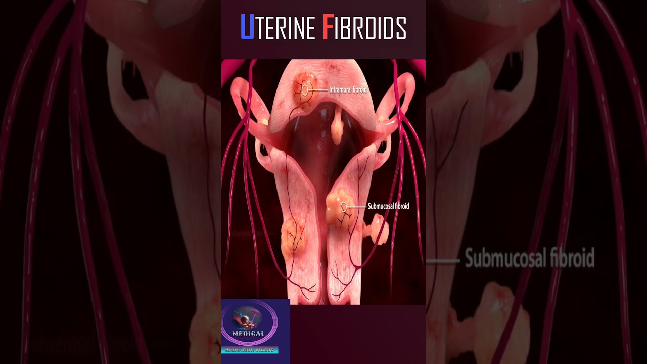 Uterine fibroids 3D animation #shorts