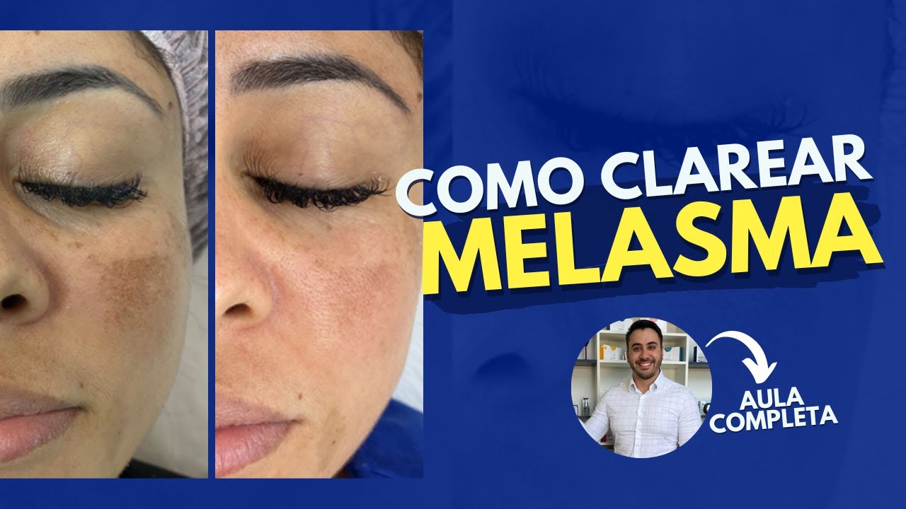 COMO CLAREAR O MELASMA COM MICROAGULHAMENTO - AULA COMPLETA