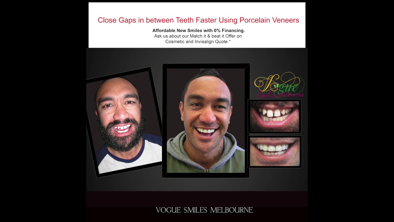 How to Close a  Gap in between teeth Without Braces ?  | VOGUE SMILES MELBOURNE