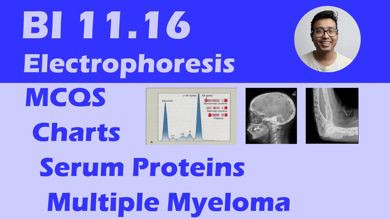 Multiple Myeloma : Analysis with Serum Protein Electrophoresis, Clinical Features and MCQS BI 11.16