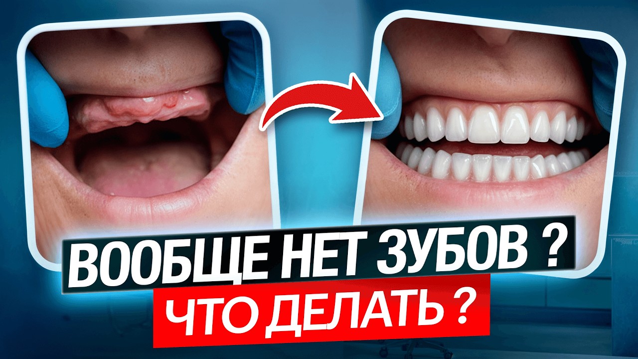 Остались без зубов: съёмные протезы или импланты — что выбрать?