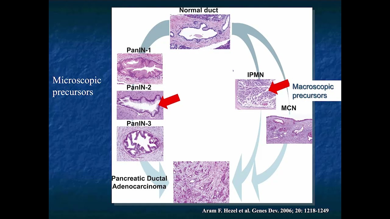 A Practical Approach to Cystic Pancreatic Masses - Part 1