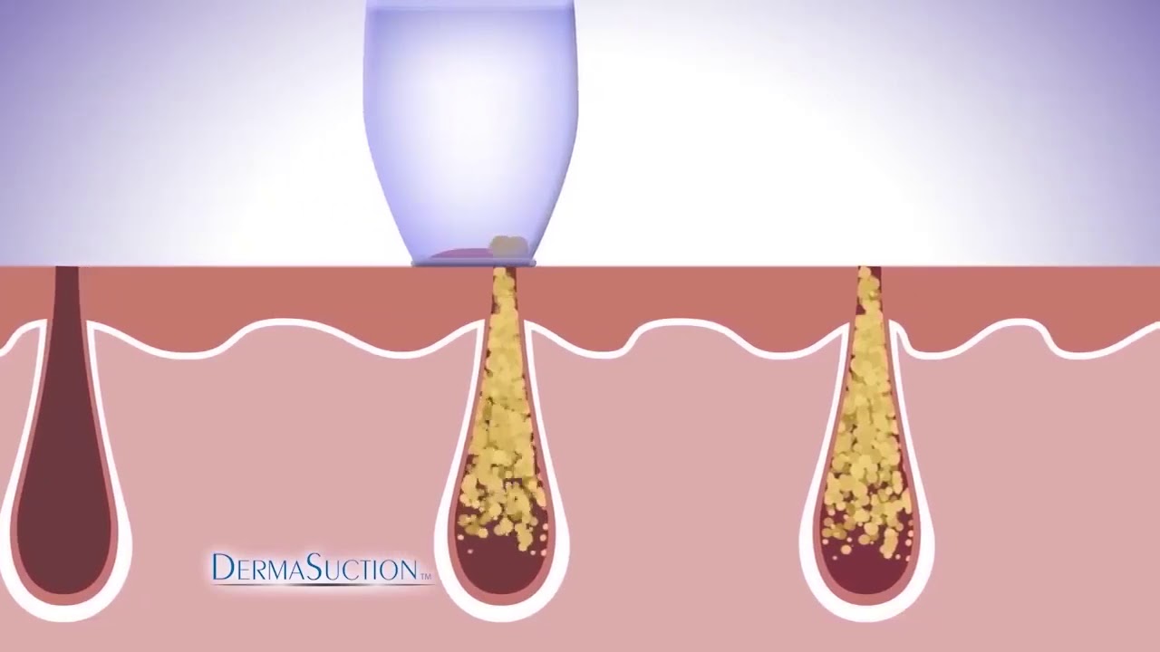 Derma Suction Device Electronic Blackhead Remover