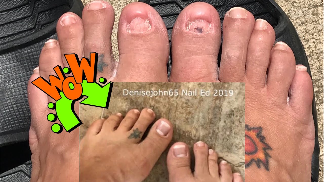 Toe Nail Extreme Transformation Dual Forms - White Tip & White Moon - Acrylic Toenails