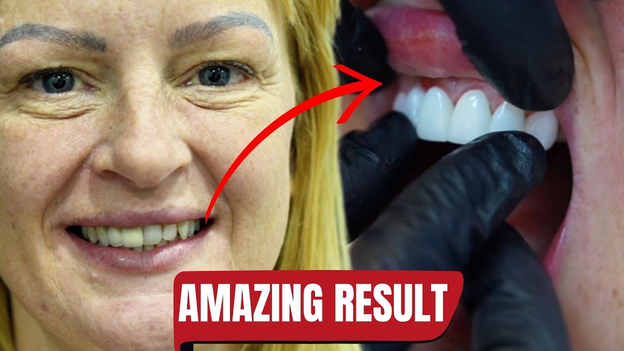 ZIRCONIUM CROWNS TREATMENT | TURKEY / ANTALYA