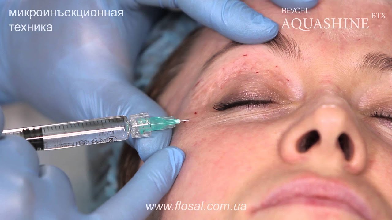 AQUASHINE BTX, микроинъекционная техника в периорбитальной области [ FloSal ]