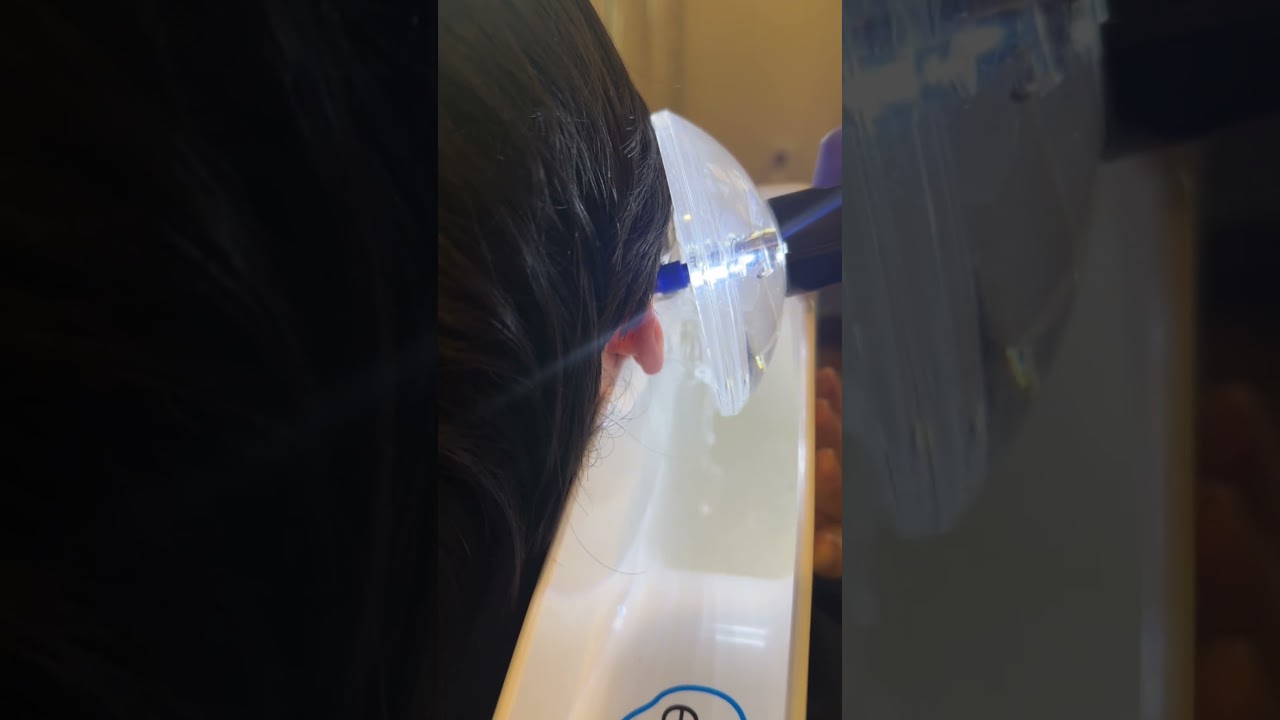 Earigator in action! #earwaxremoval #extractionsatisfaction #ears #earwax #extractions