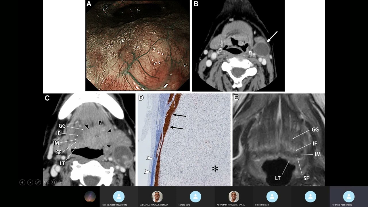 Metástasis de ganglios cervicales en Neoplasia desconocida como abordarlo