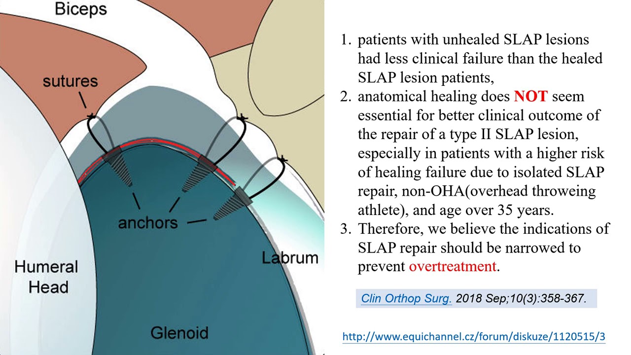 【SLAP lesion: any place for ultrasound?】