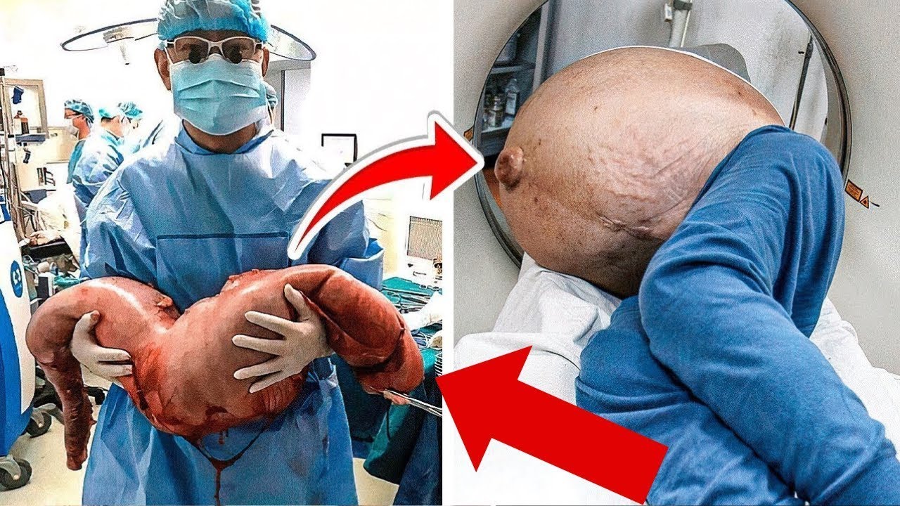 Medici scioccati rimuovono 30 chili di cacca accumulati in 22 anni