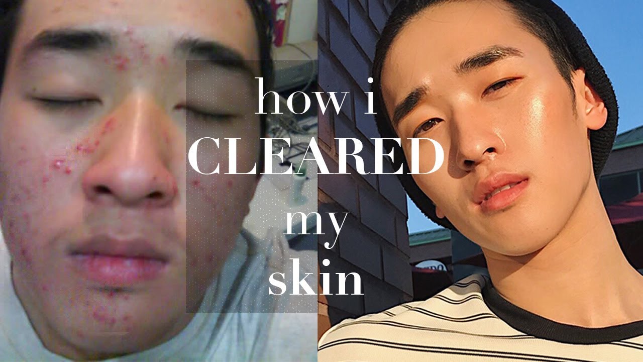 STEPS TO CLEAR SKIN | TIPS for ACNE PRONE SKIN