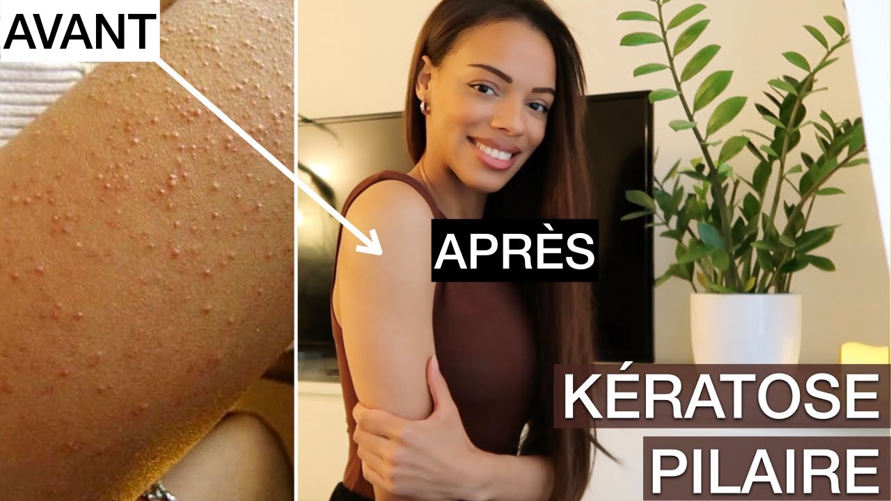S.O.S: Bras Boutonneux: Kératose Pilaire | Comment s'en débarrasser ?