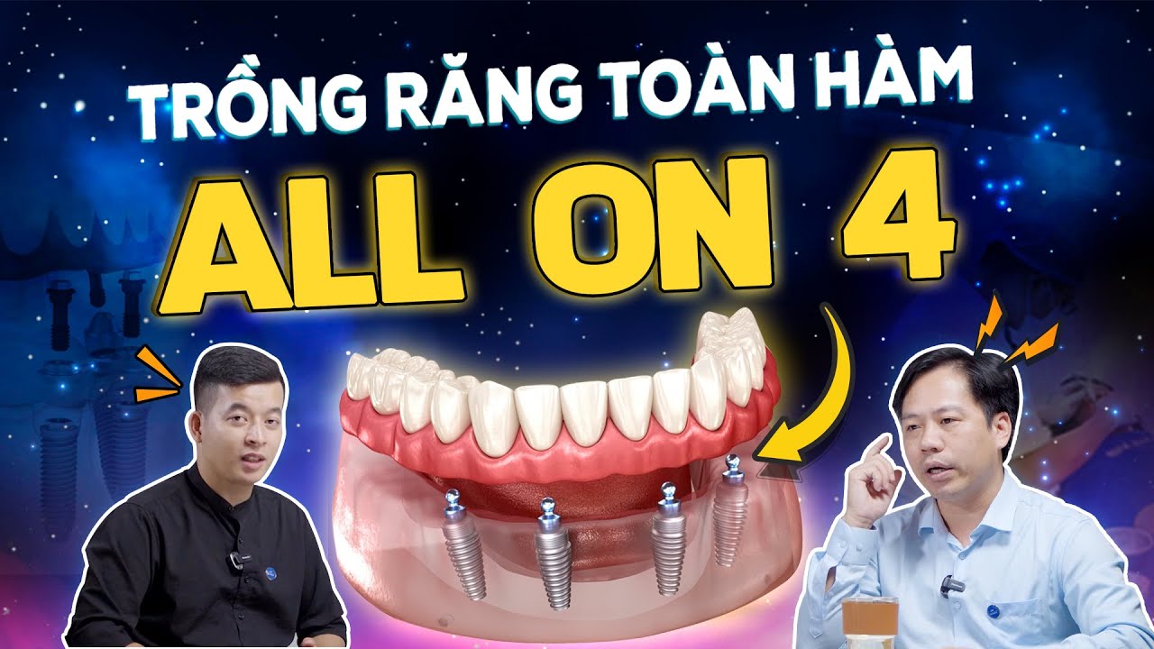 Trồng Răng Implant All-On-4: 06 Lý Do Vẫn Giữ Ngôi 