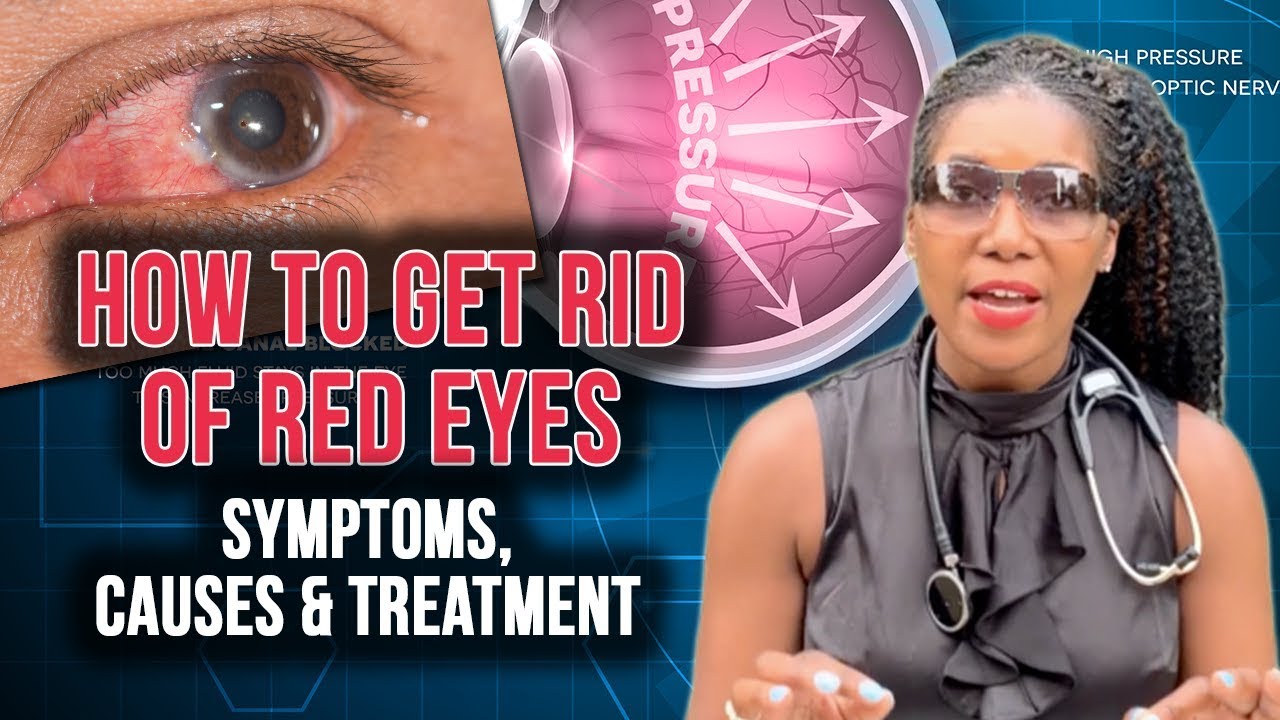 How To Get Rid Of Red Eyes: Top 5 Causes [2020]