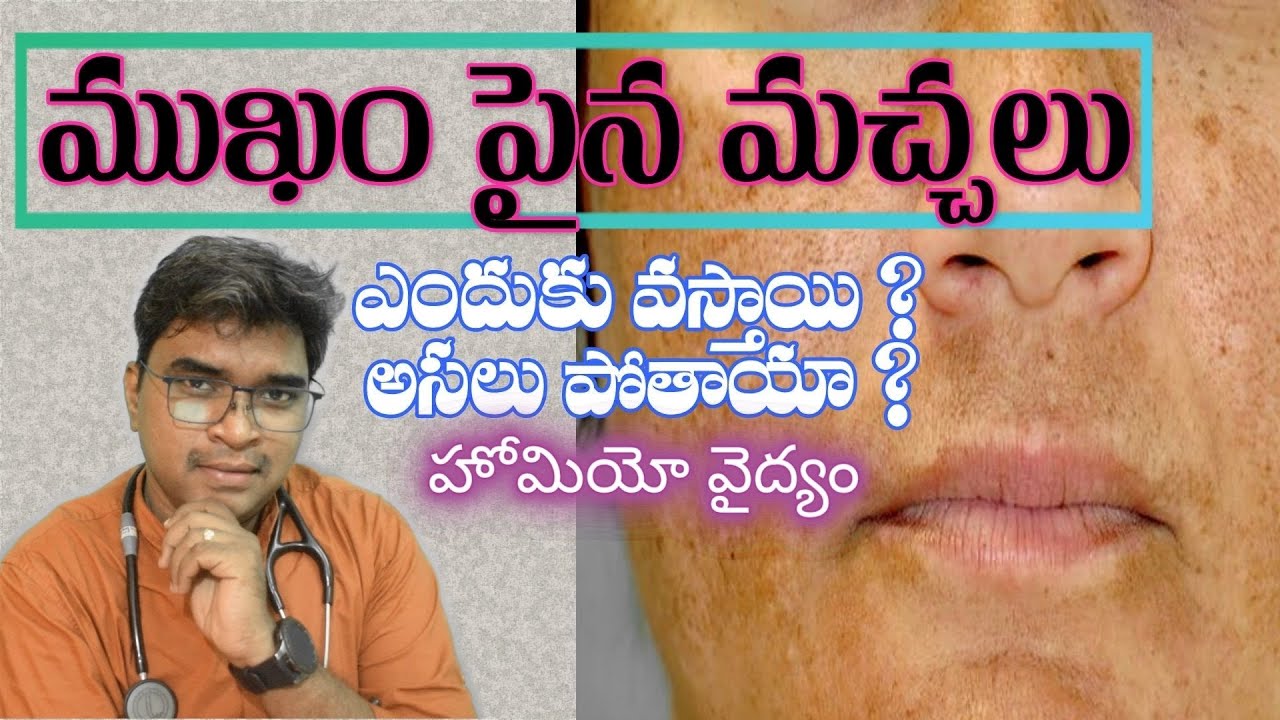 How To Cure Hyperpigmentation On Face At Home How To Remove Freckles Brown Spots Melasma