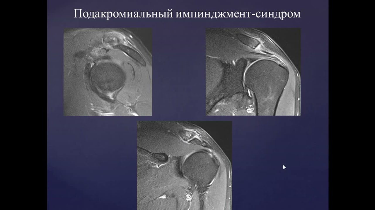 Базовый курс по МРТ  b  Лекция «МР семиотика повреждений плечевого сустава»  Лектор  Учеваткин А А