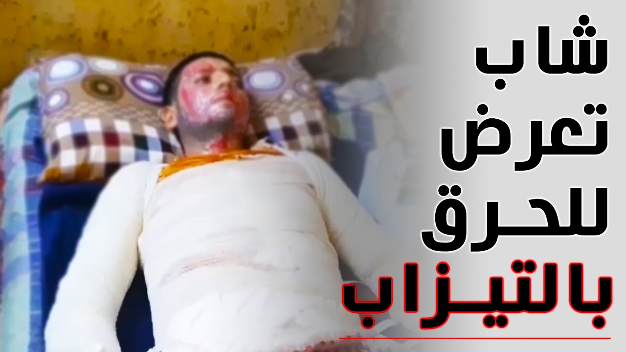 نشر عبر القنوات الفضائية شاب تعرض للحرق بمادة التيزاب ومكافحة الاجرام تلقي القبض على الجاني