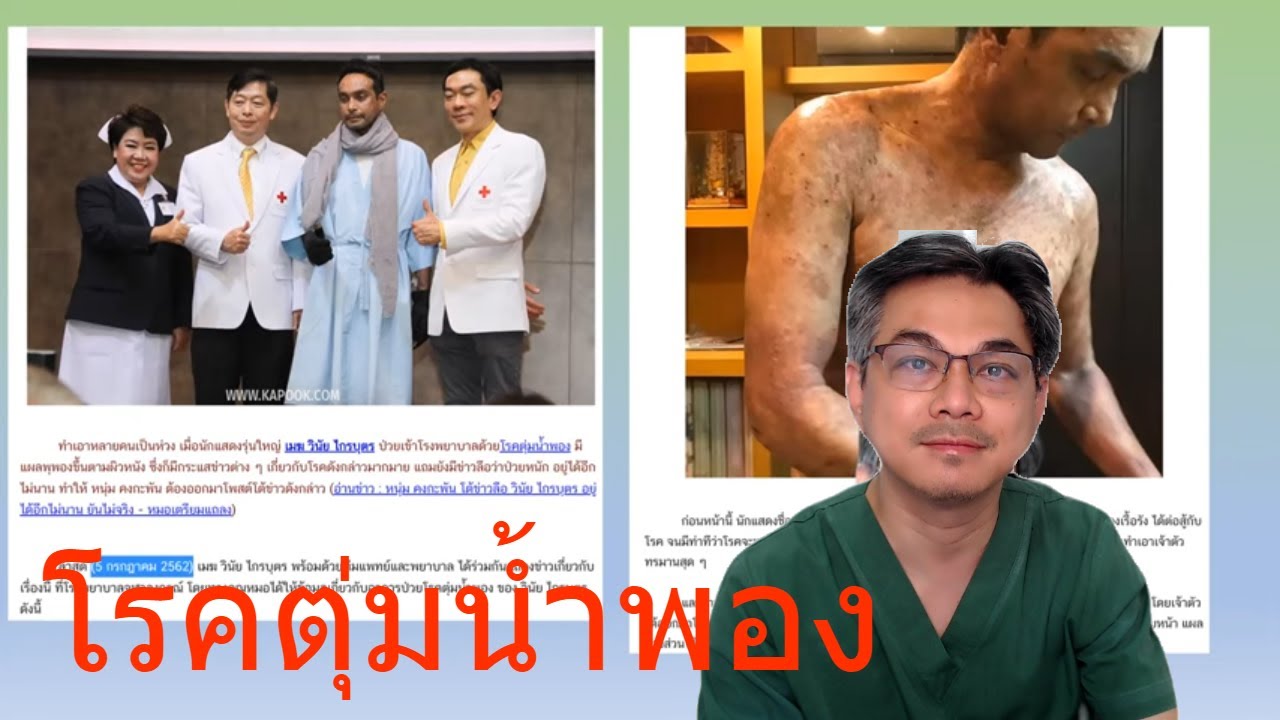 คนดังกับโรค ตอนที่ 15 : คุณเมฆ (วินัย ไกรบุตร ) โรคตุ่มน้ำพองกับวัคซีนโควิด