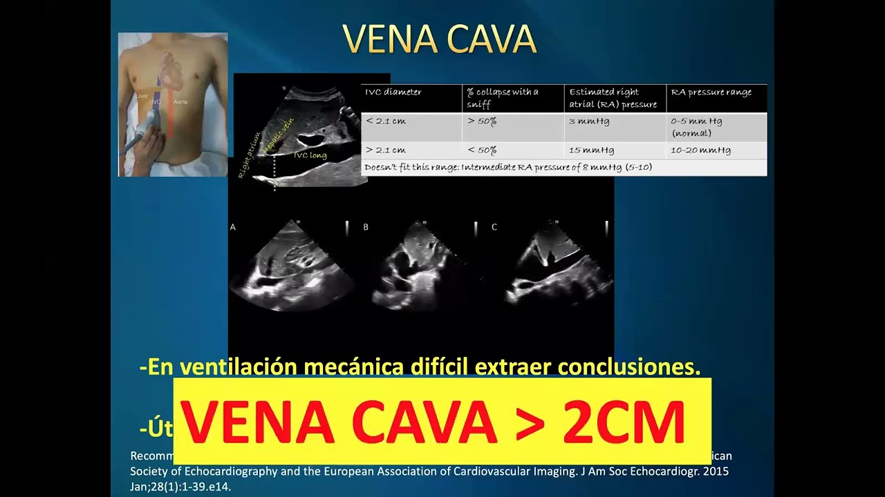 Congestión Venosa - VExUS