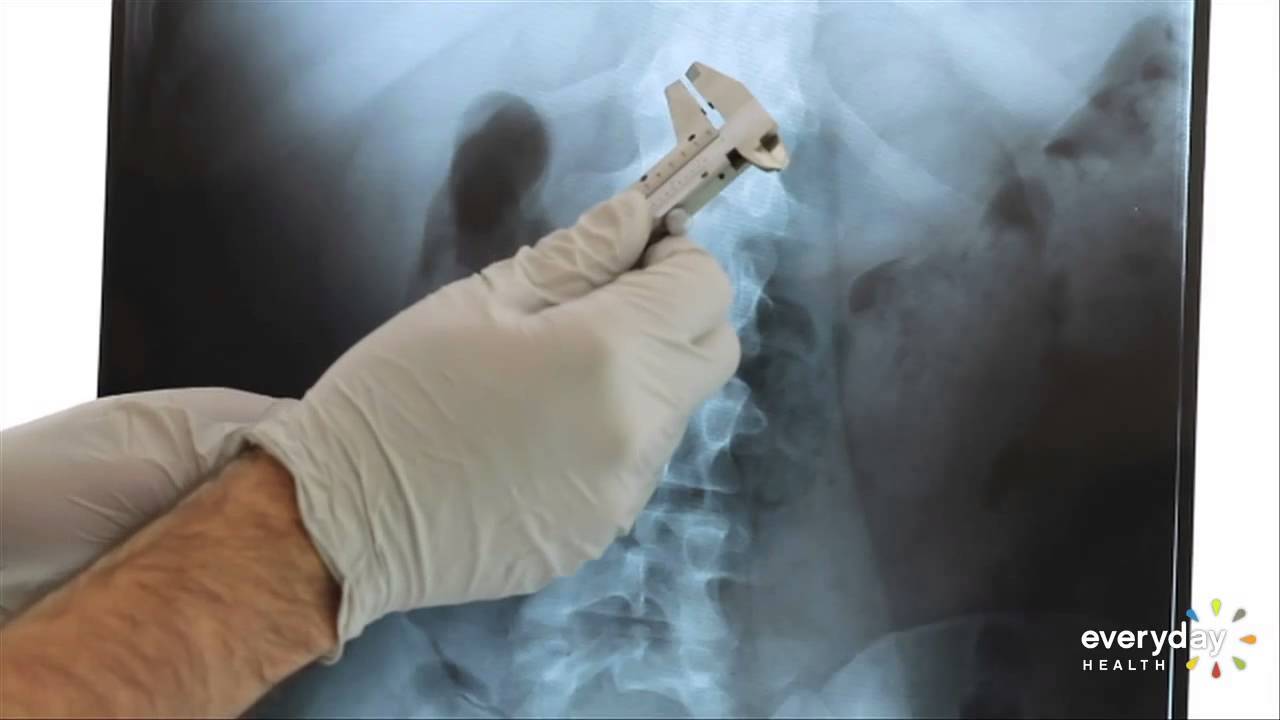 High Dose Vitamin D Prevents Fractures in Older People