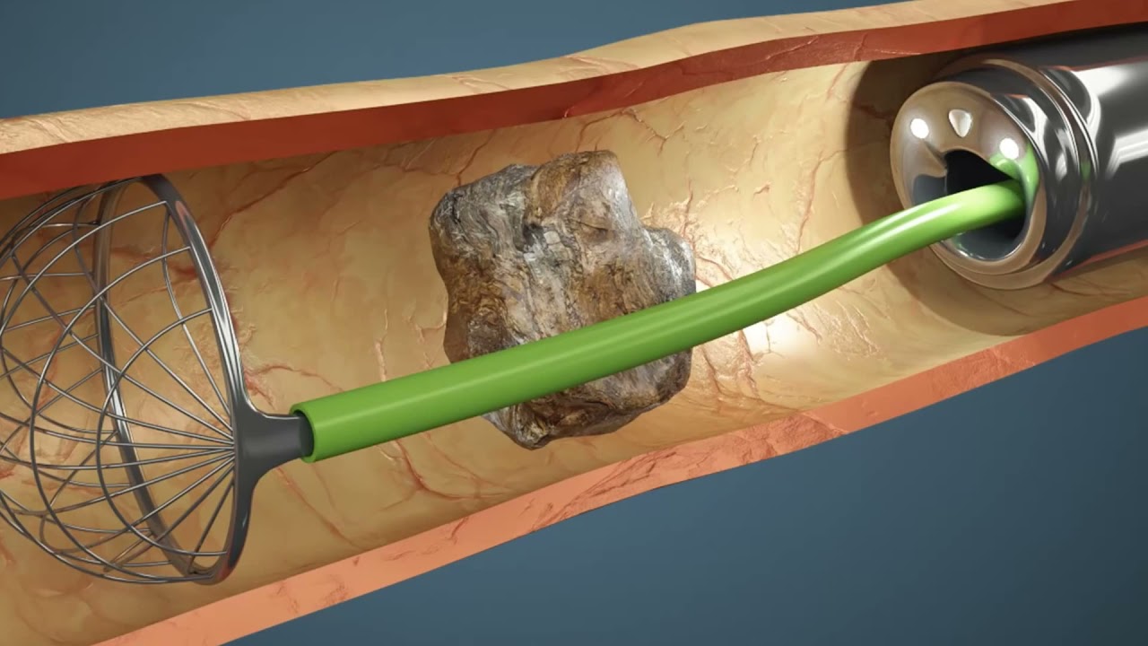 Rigid Ureteroscopy