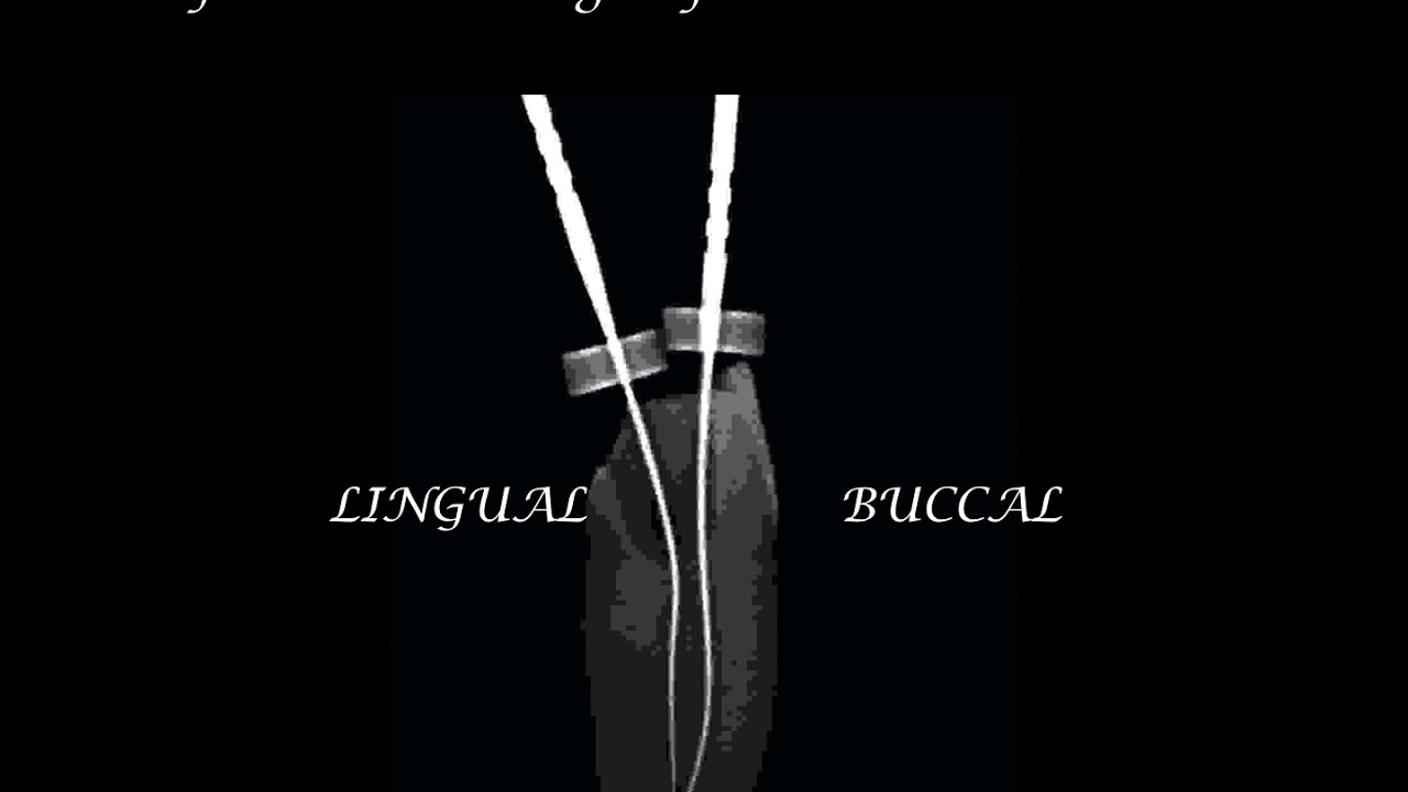 A tip to find 2 canals in lower anteriors