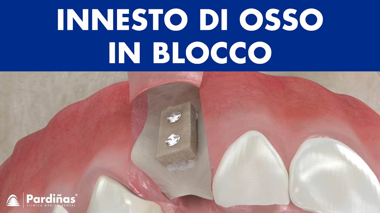 Innesto di osso in blocco ©