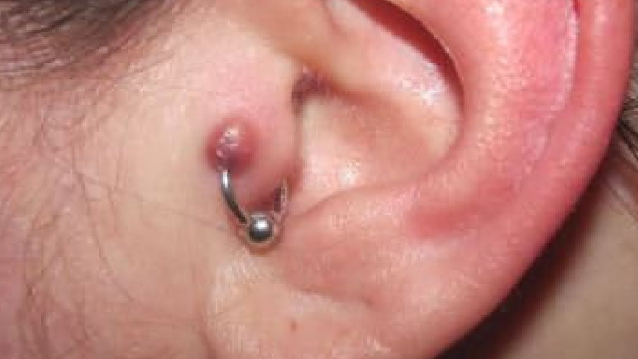 how to get rid of piercing bumps on ear