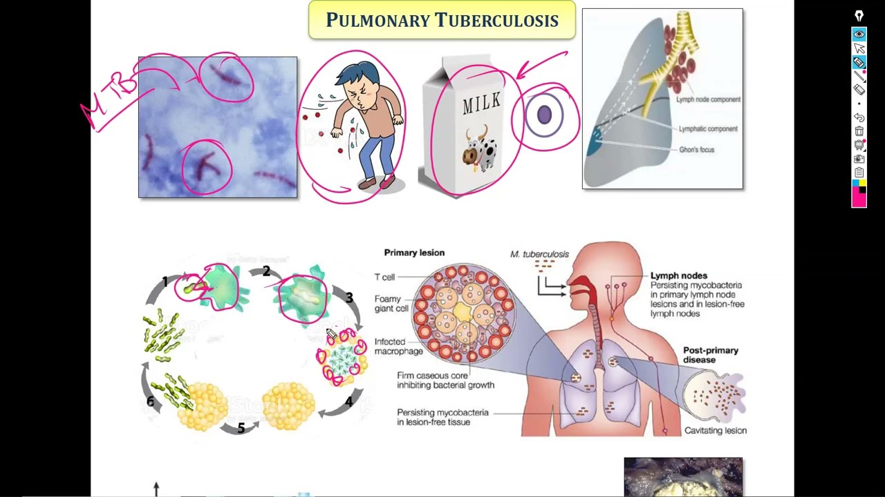 7-Tuberculosis & Sarcoidosis شرح باطنة دكتور سويلم