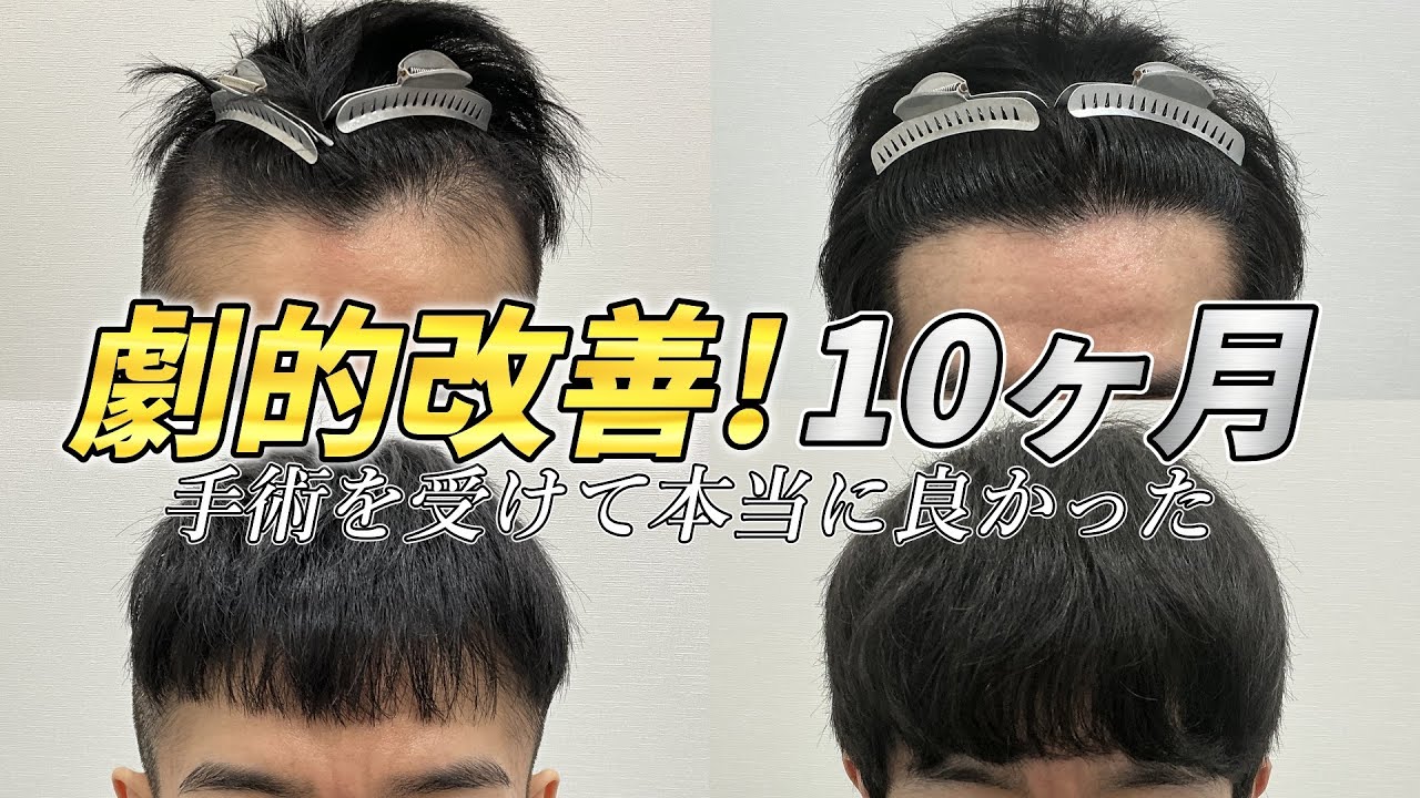 1500株の植毛手術「満足だけど気がかりなことが...」｜30代男性の10ヶ月後をチェック