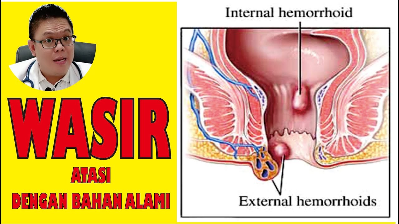 WASIR /AMBEIEN........... GUNAKAN BAHAN-BAHAN ALAMI INI