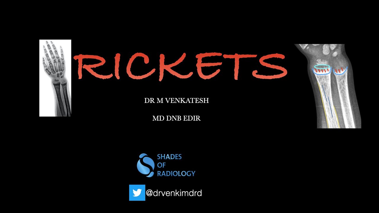 Rickets- Radiographic features