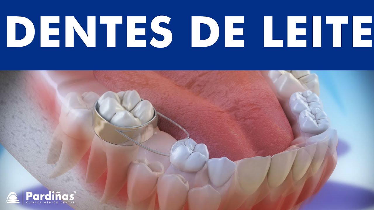 Os dentes de leite e o uso de mantenedores de espa&ccedil;o &copy;