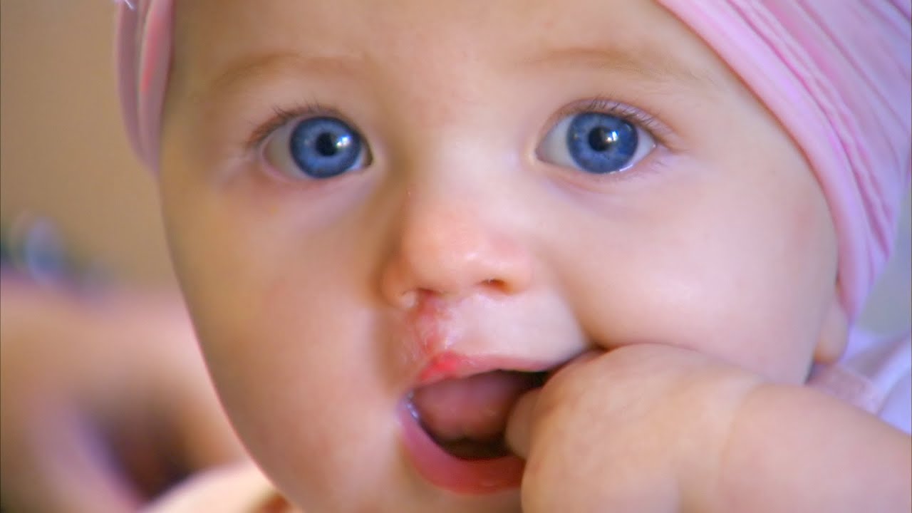 Harper Smiles with the Help of Johns Hopkins All Children's Cleft and Craniofacial Care