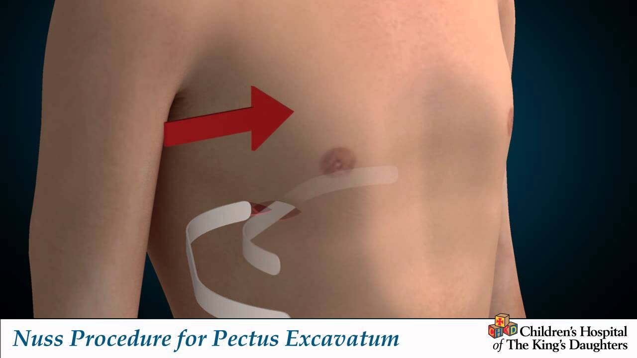 Nuss Procedure for Pectus Excavatum