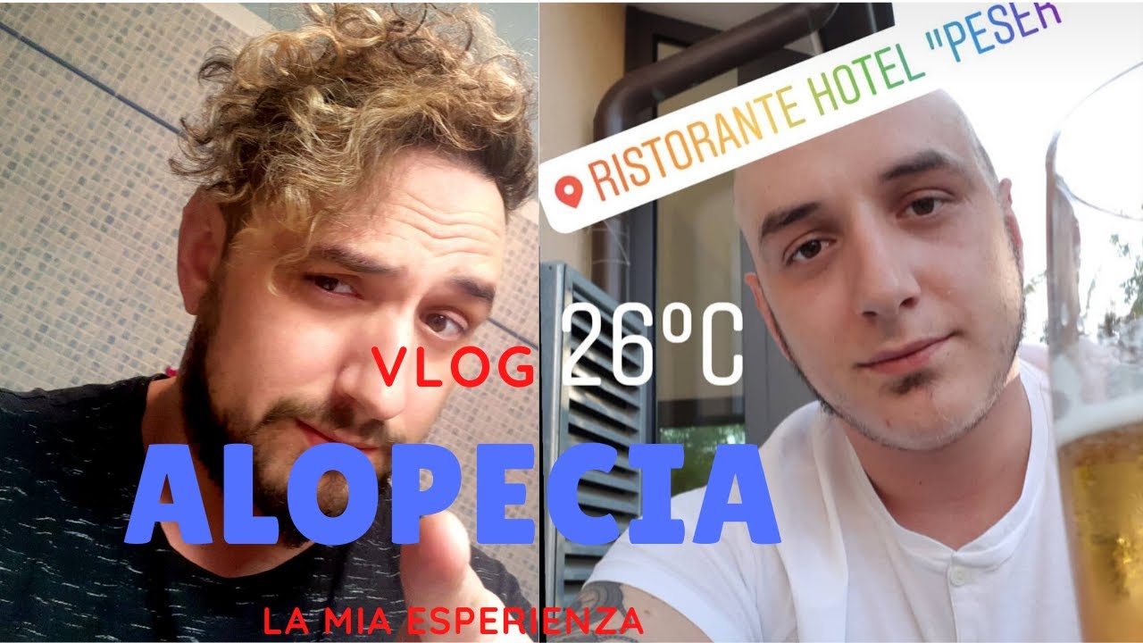 Alopecia | La mia esperienza personale | Consigli e Nozioni