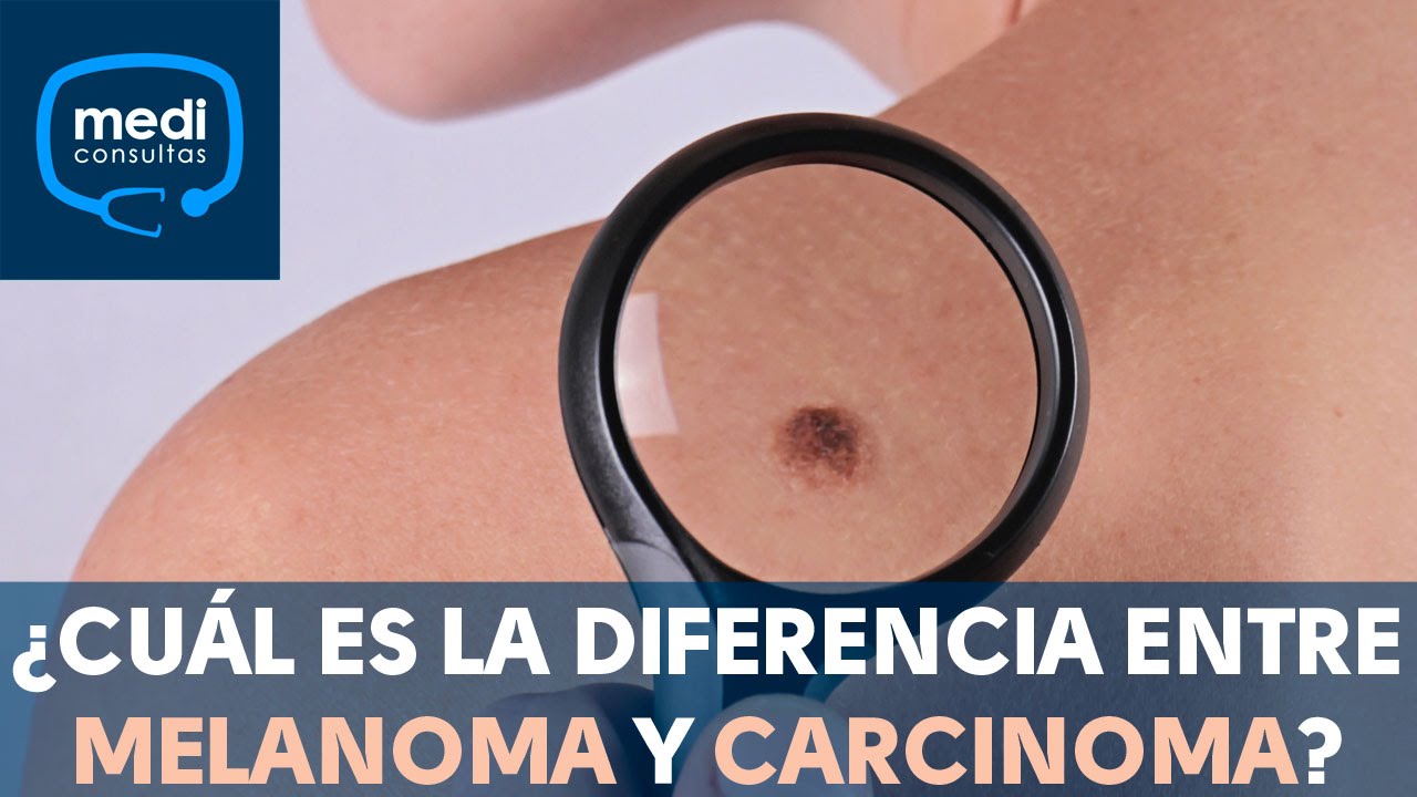 ¿Cuál es la diferencia entre melanoma y carcinoma? #MediConsultas