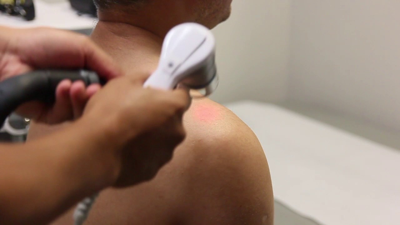 Cold Laser Therapy in Irvine
