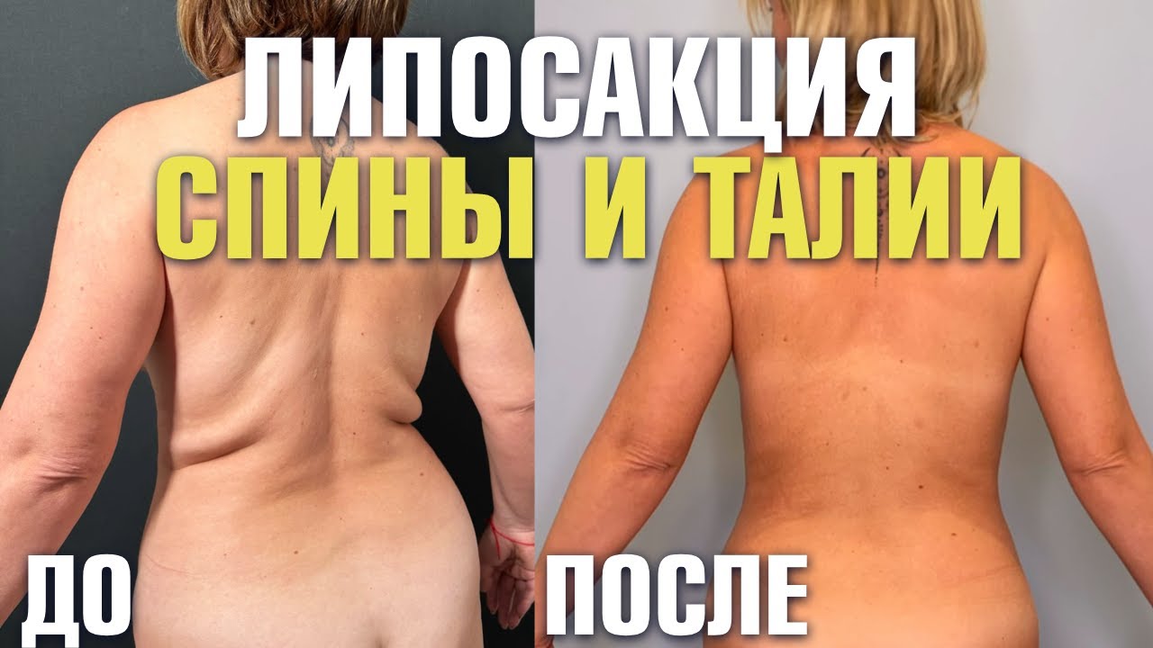 Липосакция спины и талии: до и после — реальные результаты! | Пластический хирург Шон Цион